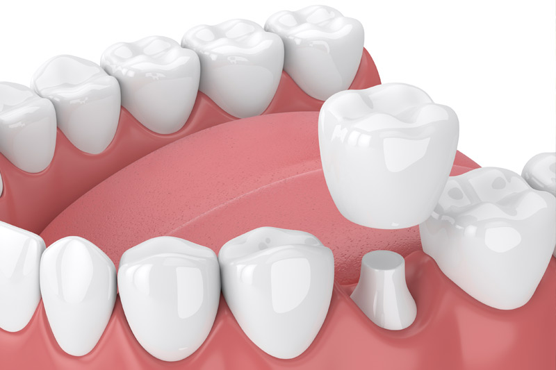 Dental Crowns and Bridges in Warrenville