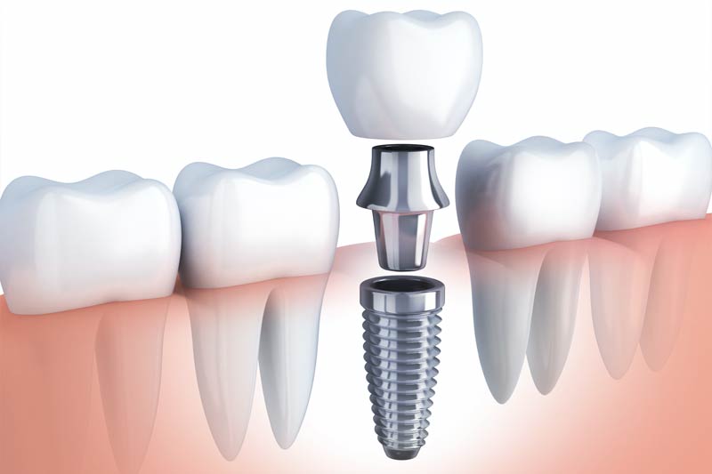 Implants Dentist in Warrenville