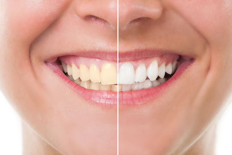 Teeth Whitening in Warrenville