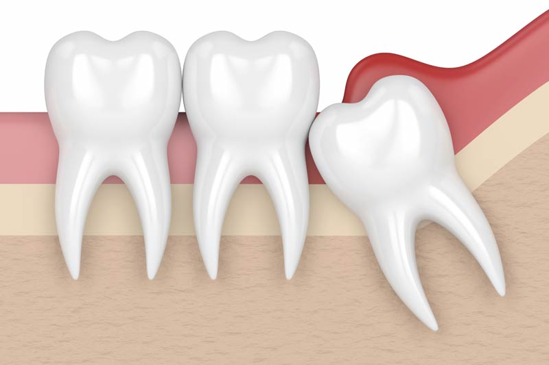 Wisdom Tooth Removal in Warrenville